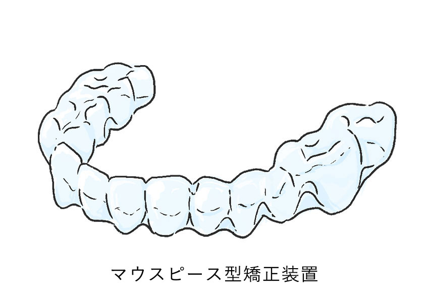 マウスピース型矯正 (インビザライン)