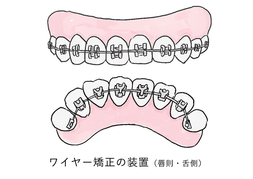 ワイヤー装置