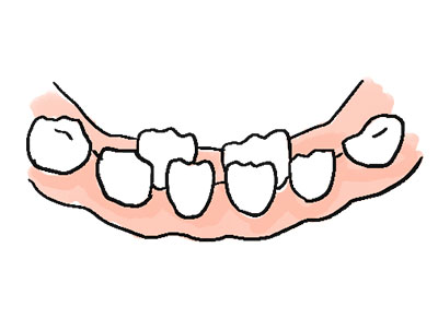 乳歯抜けずに永久歯が生える