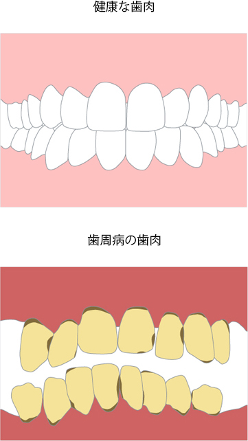 診療内容 歯周病治療 西荻窪 杉並歯科